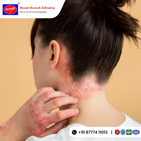 How Homeopathy Can Cure Severe Skin Disorders?